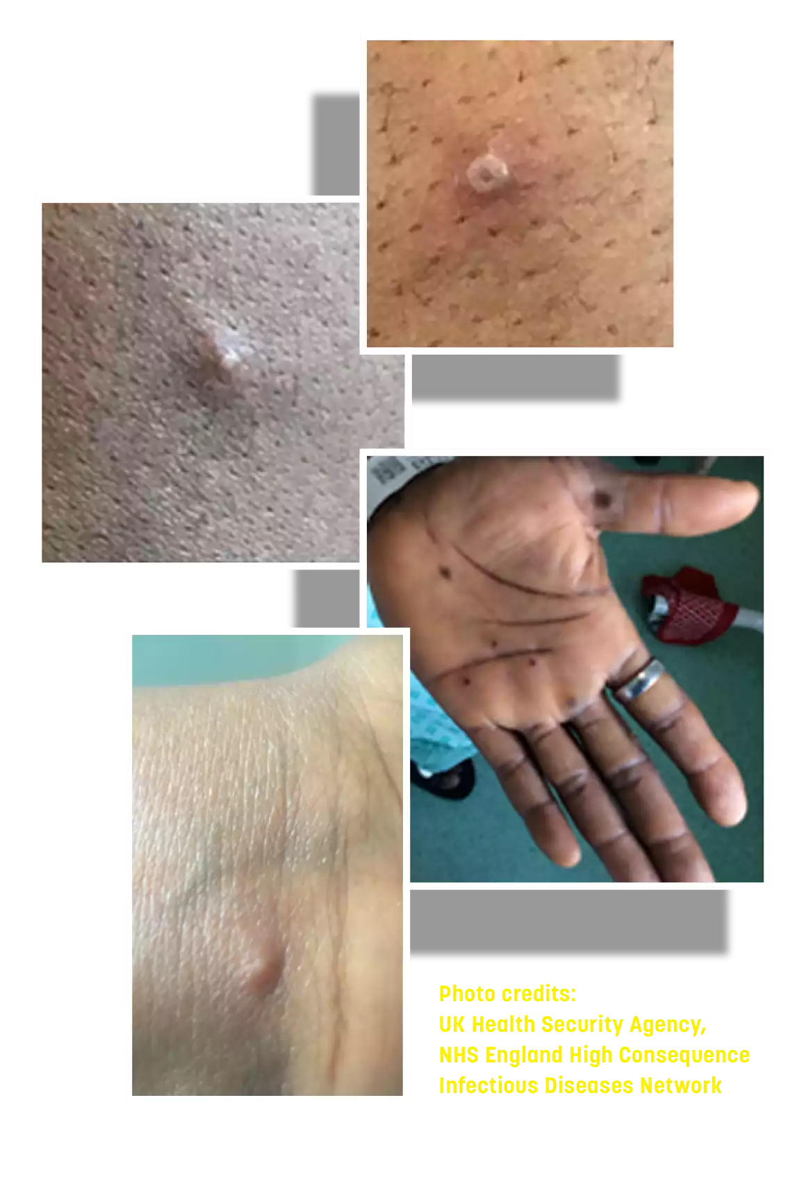 mpox (viruela del mono) llagas y erupciones en la piel de una persona, alrededor del pezón y en una mano