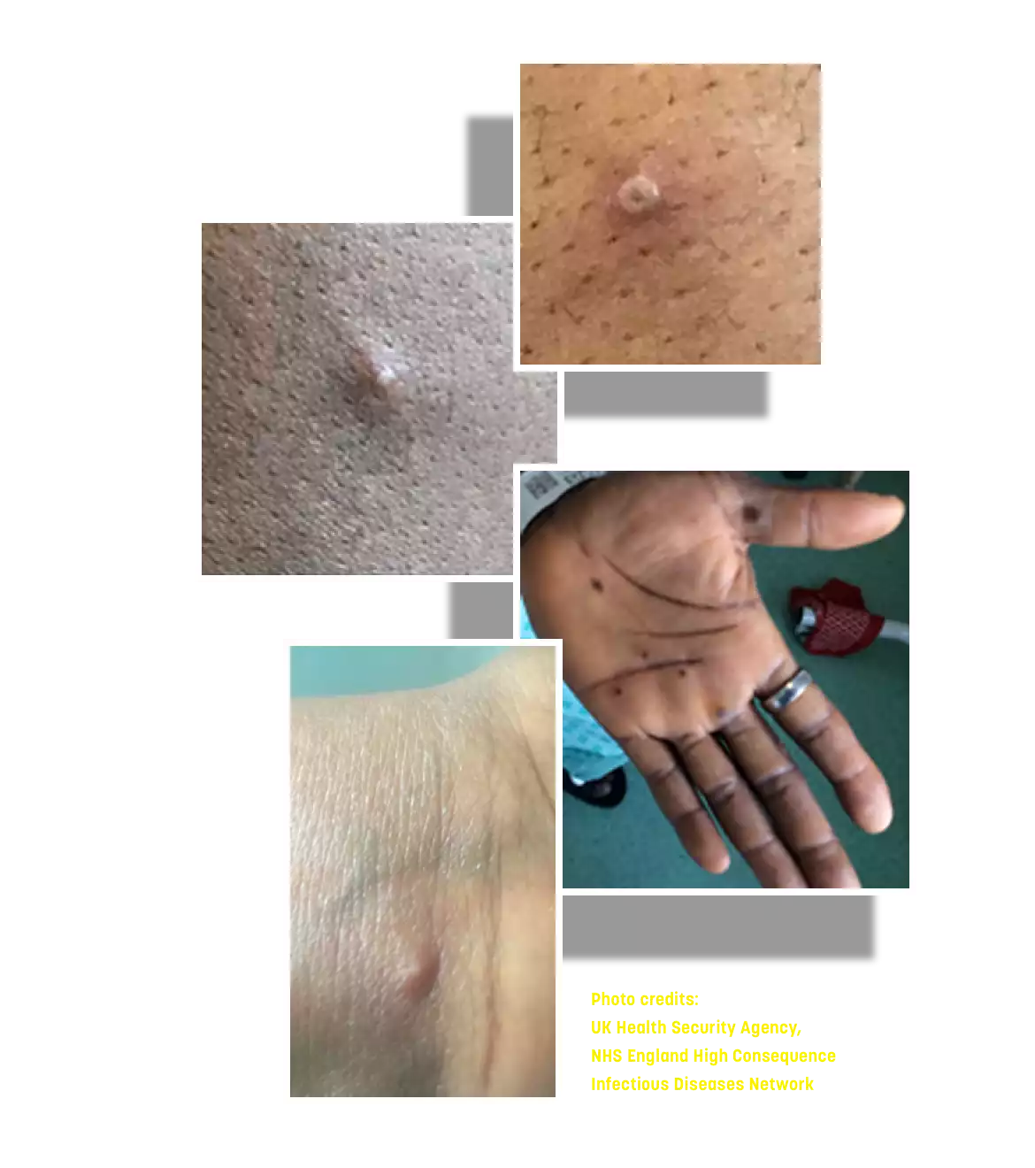 mpox (monkeypox) sores and rashes on a person's skin, around the nipple, and on a hand